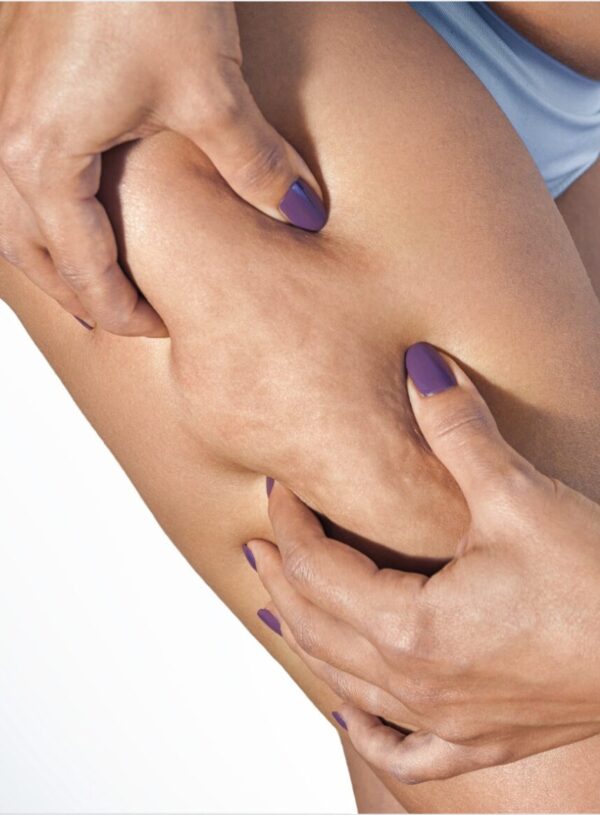 Best Cellulite Treatments